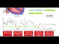 central venous pressure cvp waveform and tracing basics a c x v y explained clearly