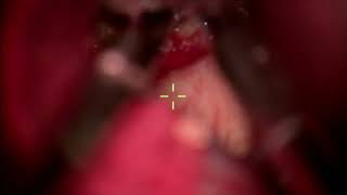 One-piece orbitozygomatic craniotomy for resection of Rathke's cleft cyst