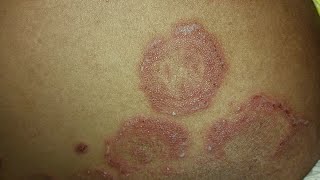 A Patient with Tinea Corporis