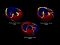 sofa interactive real time simulation of cardiac radio frequency ablation