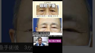 高齢者男性の眼瞼下垂手術、名古屋こいずみ形成クリニック