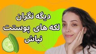 ماسک خانگی برای رفع لکه های صورت : لک صورت را چگونه برطرف کنیم؟