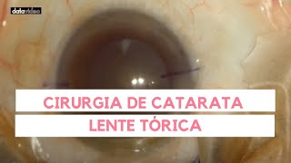 Vídeo de Cirurgia de Catarata com Implantação de Lente Intraocular Tórica | Dr. Olho