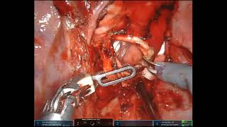 Robotic assisted right sleeve pneumonectomy