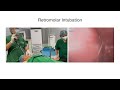 Retromolar Intubation