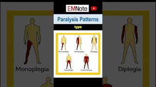 Paralysis or Weakness Patterns