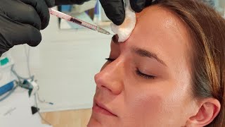 Botox Behandlung der Zornesfalte - Vorgespräch, Unterspritzung \u0026 Vorher/Nachher Aufnahme