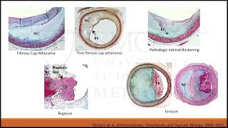 Coronary Calcified Nodule Modification: Making a Task a Little Less Sisyphean