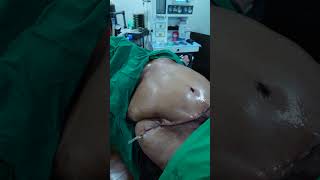 100kg Weight Patient Tummy Tuck surgery Result #shorts