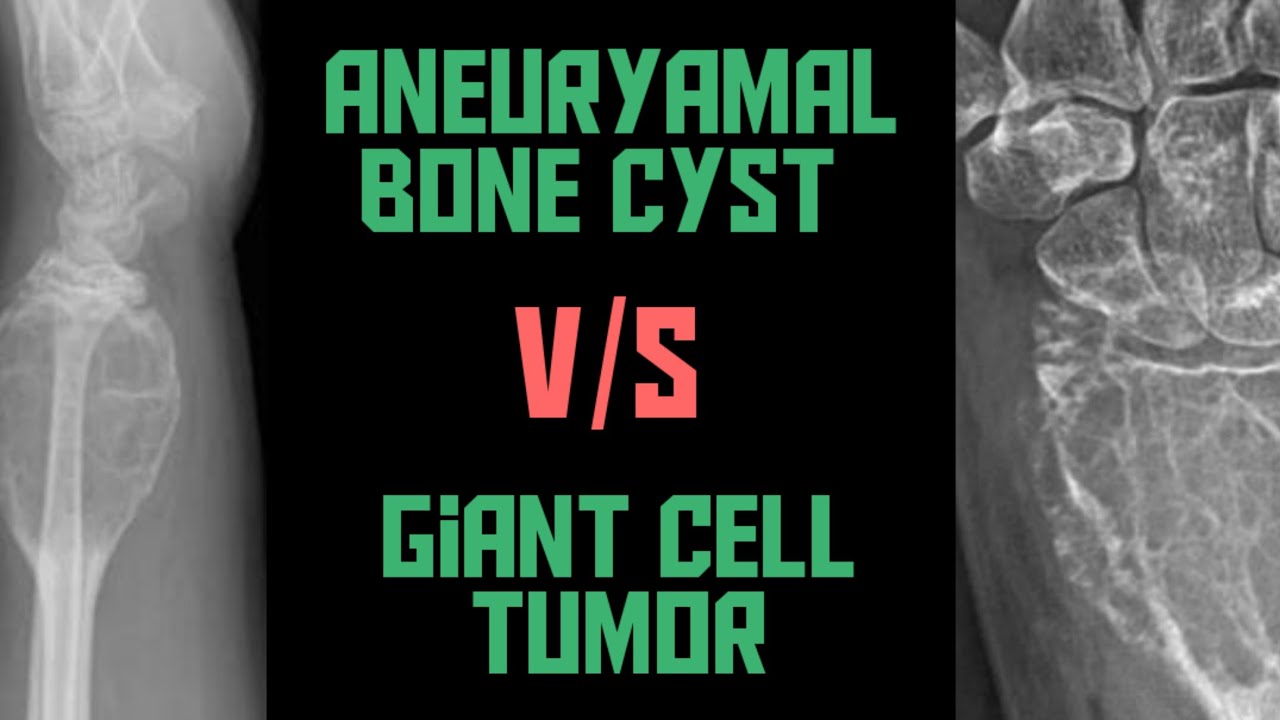 Giant Cell Tumor VS Aneurysmal Bone Cyst || GCT VS ABC || Xrays ...