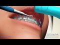 Frenectomy - Orthodontic Procedures