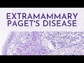 Extramammary Paget's Disease - Pathology mini tutorial