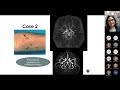 pediatric strokes 6 illustrative cases and insights lalitha sivaswamy md