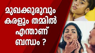 മുഖക്കുരുവും കരളും തമ്മിൽ എന്താണ് ബന്ധം ? | PIMPLES