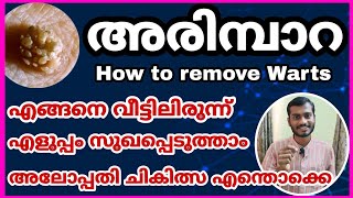 അരിമ്പാറ വീട്ടിൽ ഇരുന്നു സുഖപ്പെടുത്താം അലോപ്പതി ചികിത്സകൾ How to remove warts എങ്ങനെ പടരുന്നു Jijo