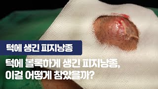 턱에 생긴 역대급 피지낭종, 얼굴에 이렇게 크게 생길 수도 있다고?