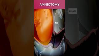 Amniotomy Procedure| Breaking Amniotic Water| #shorts #labor