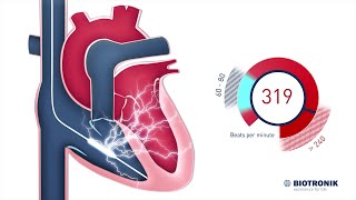 Implantable Cardioverter Defibrillator - How it works