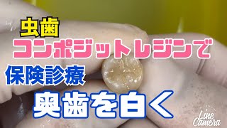 保険治療　コンポジットレジンで奥歯の虫歯を白く治すデモ　大宮　鈴木歯科医院