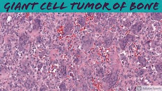 Giant Cell Tumor of Bone: Bone Pathology Basics