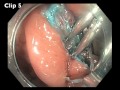 Colonoscopy: IC valve - EMR - Closure