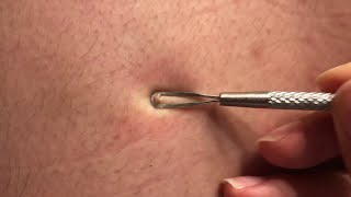 Satisfying Videos | Pimple popping - Acne - Blackheads & Cyst Compilation #49