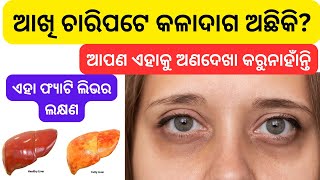 ଆଖି ଚାରିପଟେ କଳାଦାଗ ଅଛିକି? ଏହା ଫ୍ୟାଟି ଲିଭର ଲକ୍ଷଣ, ଆପଣ ଏହାକୁ ଅଣଦେଖା କରୁନାହାଁନ୍ତି ତ /  Fatty liver