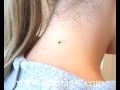 Skin Tag Removal in 15 Mins @ Home! Skin Tag Removal in 15 Mins @ Home!