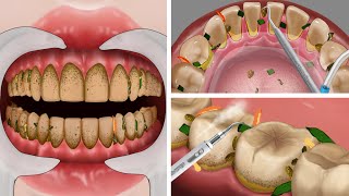 ASMR the best treatment for teeth, get tartar | 현실적인 치과 치료 애니메이션