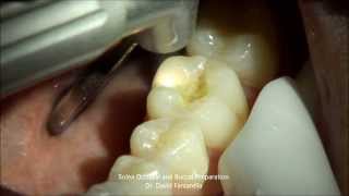 Solea Laser Occlusal Preparation - Dr. David Fantarella