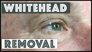 Removing a whitehead from the conjunctival rim