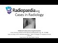 Unilateral tuberculous lung destruction (Radiopaedia.org) Cases in Radiology