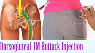 How to give an IM Intramuscular injection in the Buttocks | Hip Dorsogluteal Injection Technique