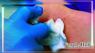 Removal of a Pyogenic Granuloma || Pimple Hub's