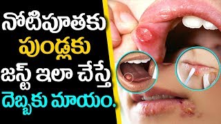 నోటి పూతలు, పుండ్లకు జస్ట్ ఇలా చేస్తే దెబ్బకు తగ్గిపోతాయి | Noti Pootha | Mouth Ulcers | Health Tips