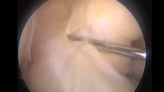 Anatomic ACL Reconstruction