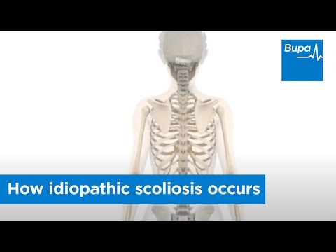 How idiopathic scoliosis occurs How idiopathic scoliosis occurs