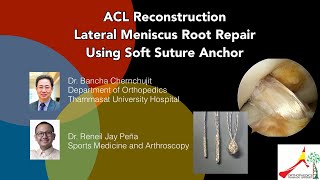 ACLR-LateralMeniscusRootRepairWithQ-fixส่องกล้องซ่อมเอ็นไขว้หน้าฉีกขาดซ่อมรากหมอนรองเข่าด้วยสมอQ-Fix