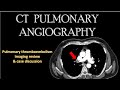 CT PULMONARY ANGIOGRAPHY |PULMONARY THROMBOEMBOLISM| Pulmonary vessels anatomyl Triple rule out CTI