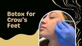 Botox for Crow's Feet | West Hollywood, CA | Dr. Jason Emer