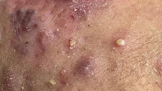 Acne Treament Under The Skin #055