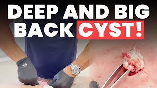 DEEP AND BIG BACK CYST!