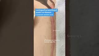 รักษาแผลเป็นนูนคีลอยด์จากผ่าตัดคลอด Cesarean section scar treatment Picosecond Laser l หมอรุจชวนคุย