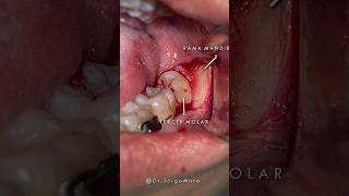 PASO A PASO: CIRUGÍA TERCER MOLAR 📸 #oralsurgeon #dentistry #drjorgemata #odontologystudent