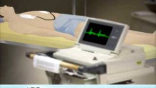 Electrical Cardioversion