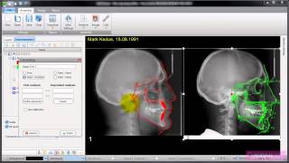 AudaxCeph - Structural superimposition