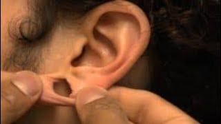 Ear Hole closing with out sargary -कान के छेद को छोटा करने के आसान उपाय- Kaan Ke Ched Ka Ilaj
