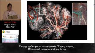 Υπερηχογράφημα σε μονοχοριακές δίδυμες κυήσεις -  Μαρία Σίμου, MD, PhD