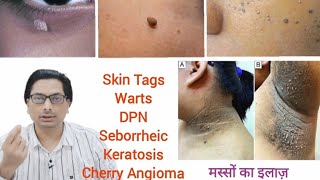 Skin Tags, Warts, DPN, Seborrheic Keratosis, Cherry Angioma मस्सों का इलाज़ Wart vs Skin Tag #skintag