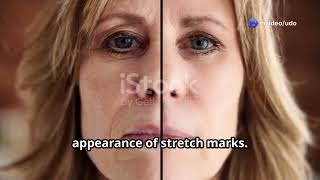 How to remove stretch marks on the body/ most effective way